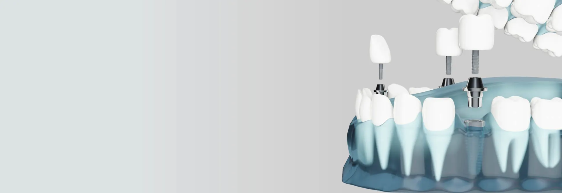 Computer guided dental implants at Village Dental Kogarah