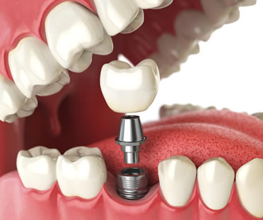 dental implants dentist