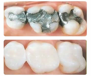 White fillings