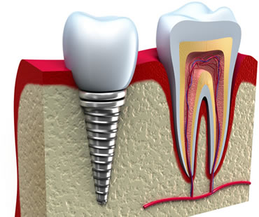 Reaping the Benefits of Dental Implants
