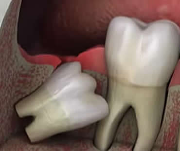 Wisdom teeth dentist in Ryde, Campsie, Kogarah, and Haymarket