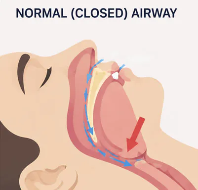 closed airway sleep apnea diagram