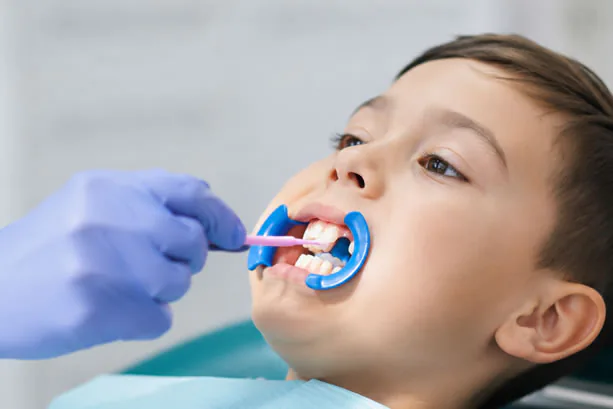 dental sealant aplied to front of teeth dental sealant aplied to front of teeth
