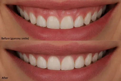 gum contoring before and after