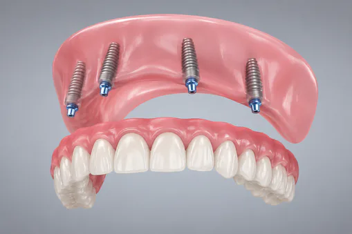 implant supported denture Implant supported dentures