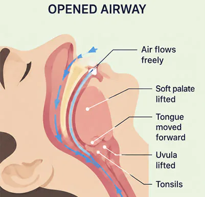 open-airway-sleep-apnea-diagram open airway sleep apnea diagram