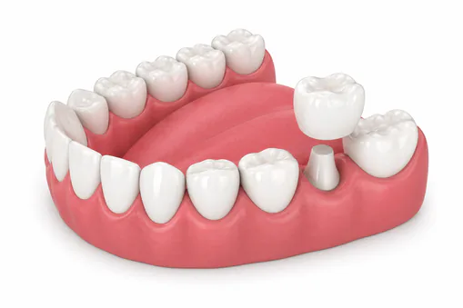 single dental crown