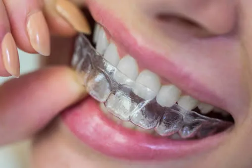 invisalign 